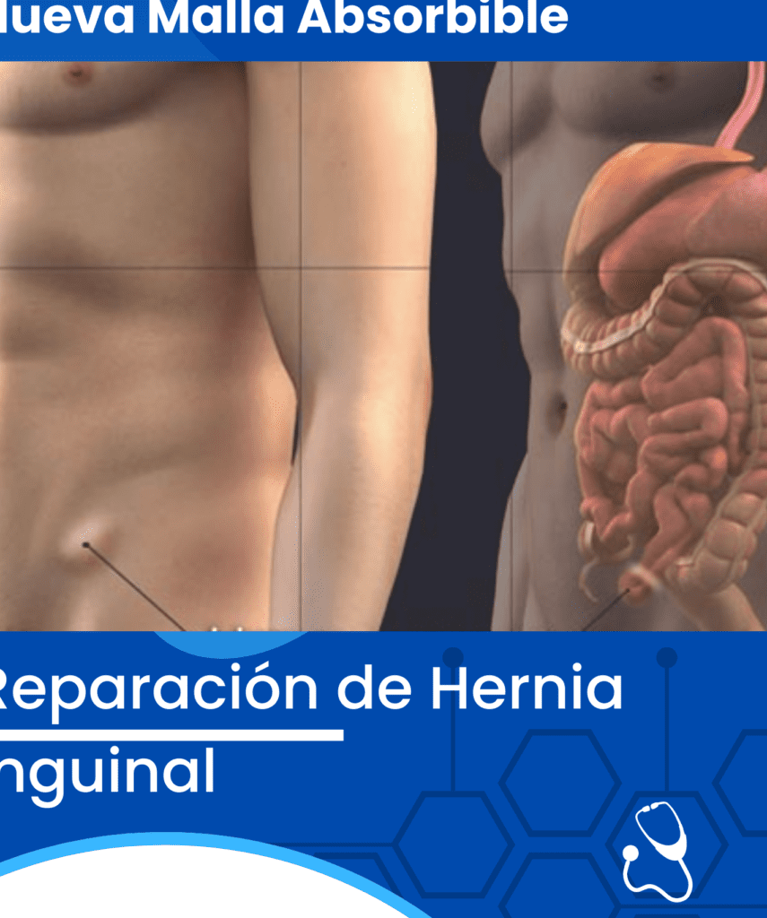 Descubre cómo ahorrar en grande con la cirugía de hernia en México: precios increíbles te sorprenderán descubre como ahorrar en grande con la cirugia de hernia en mexico precios increibles te sorprenderan