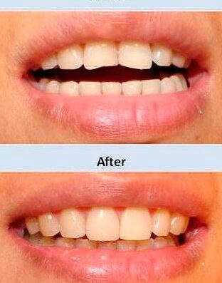 Descubre cómo el composite bonding puede mejorar tu sonrisa en México descubre como el composite bonding puede mejorar tu sonrisa en