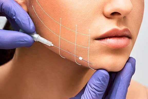 Descubre cómo el PDO Thread Lift en México rejuvenece tu piel de manera natural descubre como el pdo thread lift en mexico rejuvenece tu piel de manera natural