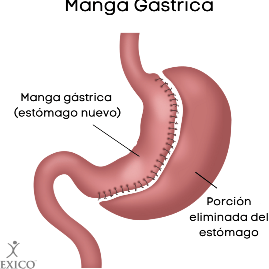 Descubre cómo la manga gástrica en Puerto Vallarta, México, puede cambiar tu vida para siempre descubre como la manga gastrica en puerto vallarta mexico puede cambiar tu vida para siempre