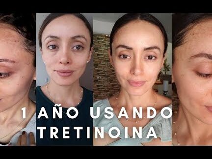 ¡Descubre cómo la tretinoina crema 0.05 está revolucionando la belleza en México! ¡No puedes perderte los resultados sorprendentes que está obteniendo! descubre como la tretinoina crema 0 05 esta revolucionando la belleza en mexico no puedes perderte los resultados sorprendentes que esta obteniendo