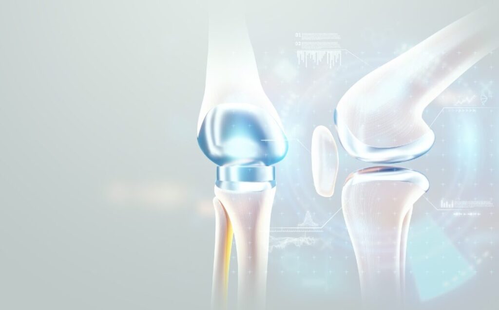 ¡Descubre cómo México revoluciona la cirugía de reemplazo de rodilla y cambia vidas! descubre como mexico revoluciona la cirugia de reemplazo de rodilla y cambia vidas