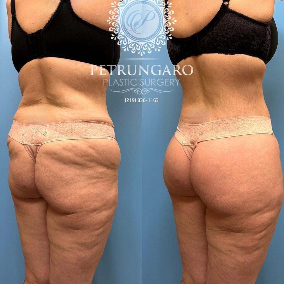 ¡Descubre el secreto detrás del increíble cambio de cuerpo con el 360 Body Lift Mexico! ¡No podrás creer los resultados impactantes! descubre el secreto detras del increible cambio de cuerpo con el 360 body lift mexico no podras creer los resultados impactantes 1