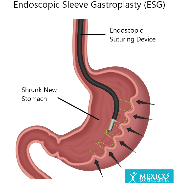 ¡Descubre el secreto revolucionario de la endoscopic sleeve gastroplasty en México y transforma tu vida! descubre el secreto revolucionario de la endoscopic sleeve gastroplasty en mexico y transforma tu vida
