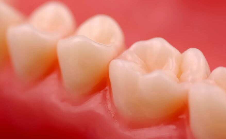 Descubre la solución económica para recuperar tu sonrisa: ¡Conoce el increíble costo de los injertos de encía en México! descubre la solucion economica para recuperar tu sonrisa conoce el increible costo de los injertos de encia en