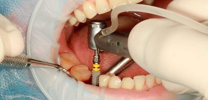 Descubre las ventajas de los mini implantes dentales en México: La solución eficaz para una sonrisa perfecta descubre las ventajas de los mini implantes dentales en mexico la solucion eficaz para una sonrisa perfecta