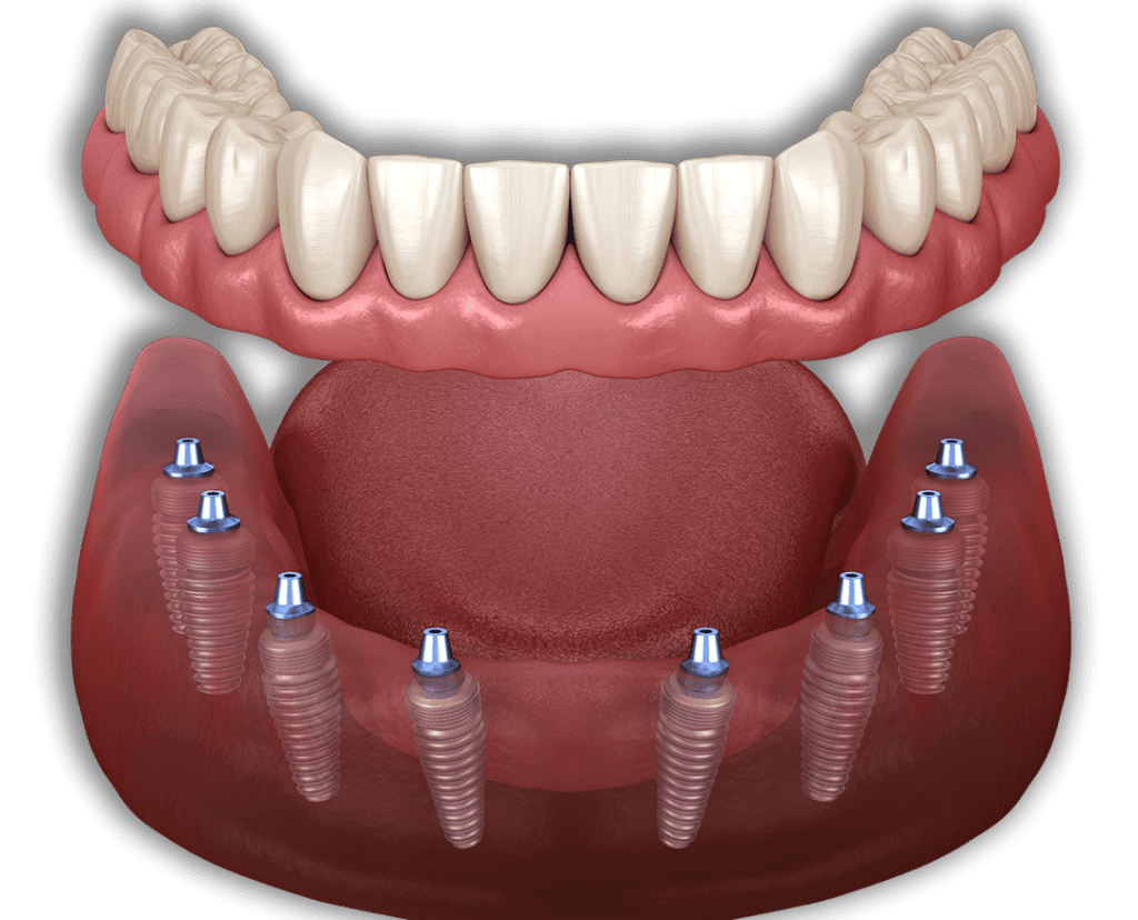 descubre los beneficios de los implantes dentales en san miguel de allende mexico