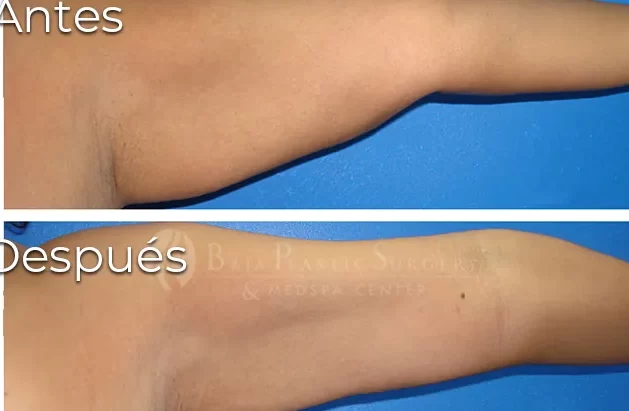 Descubre los beneficios y resultados sorprendentes de la laser lipo en Tijuana, México descubre los beneficios y resultados sorprendentes de la laser lipo en tijuana mexico 1