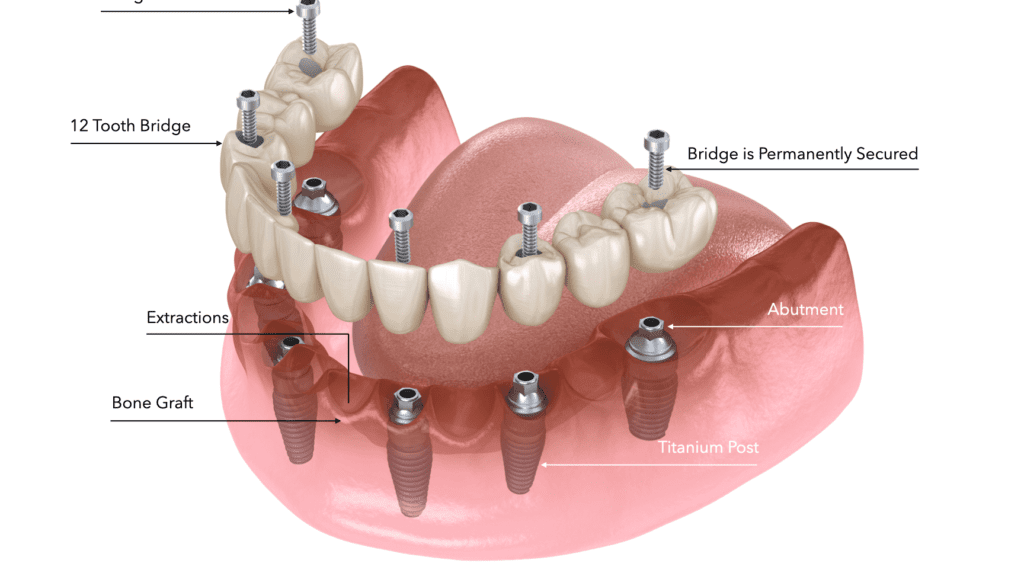 Descubre los precios asequibles de la unión dental en México: todo lo que necesitas saber descubre los precios asequibles de la union dental en mexico todo lo que necesitas saber