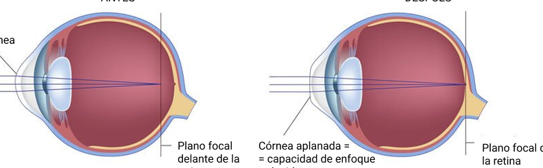 La cirugía LASIK en Guadalajara, México: la solución para una visión clara y sin lentes la cirugia lasik en guadalajara mexico la solucion para una vision clara y sin lentes