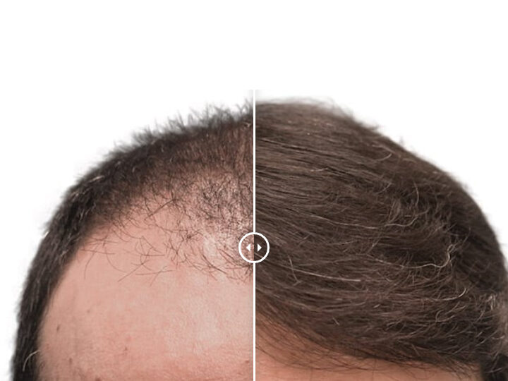 La solución definitiva para la pérdida de cabello: Artas Hair Transplant en México la solucion definitiva para la perdida de cabello artas hair transplant en