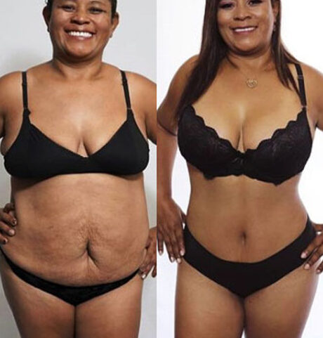 transforma tu figura con el increible lower body lift en mexico descubre como lograrlo