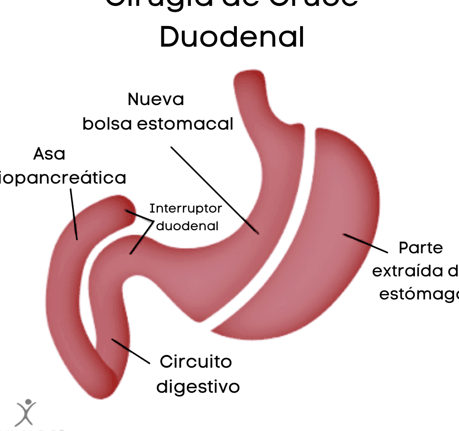 ¡Descubre cómo la cirugía de interruptor duodenal en México está cambiando vidas y transformando cuerpos! descubre como la cirugia de interruptor duodenal en mexico esta cambiando vidas y transformando cuerpos