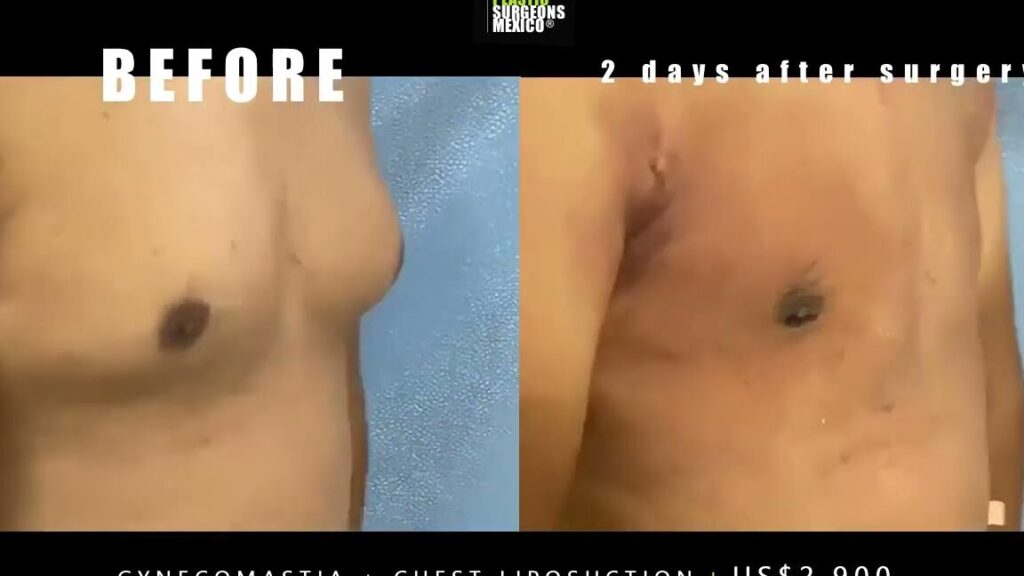 Descubre cómo la cirugía gyno en México te dará resultados asombrosos a un precio increíble descubre como la cirugia gyno en mexico te dara resultados asombrosos a un precio increible