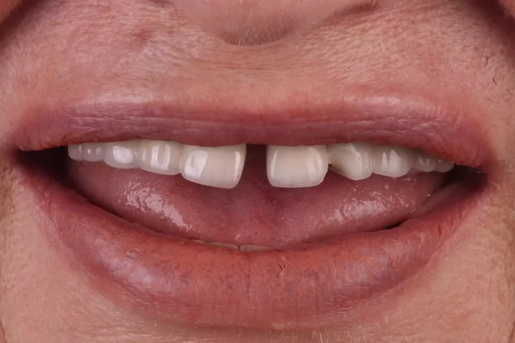 descubre como los implantes dentales en tijuana mexico estan revolucionando sonrisas no creeras los resultados