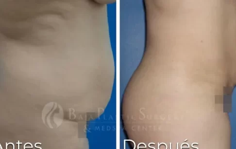 ¡Descubre el secreto de la liposucción láser en Tijuana, México! ¡Elimina la grasa de forma rápida y segura! descubre el secreto de la liposuccion laser en tijuana mexico elimina la grasa de forma rapida y segura
