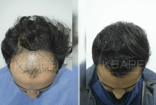 Descubre la increíble transformación que el injerto de cabello en México puede hacer por ti descubre la increible transformacion que el injerto de cabello en mexico puede hacer por ti