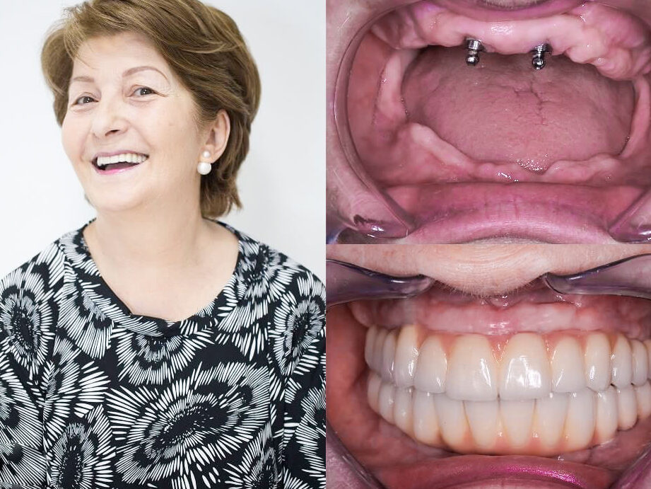 ¡Descubre las mejores reseñas de implantes dentales en México! Te sorprenderás con nuestros hallazgos descubre las mejores resenas de implantes dentales en mexico te sorprenderas con nuestros hallazgos