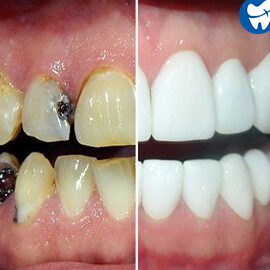 Implantes dentales en Progreso, México: la solución efectiva para una sonrisa perfecta implantes dentales en progreso mexico la solucion efectiva para una sonrisa perfecta