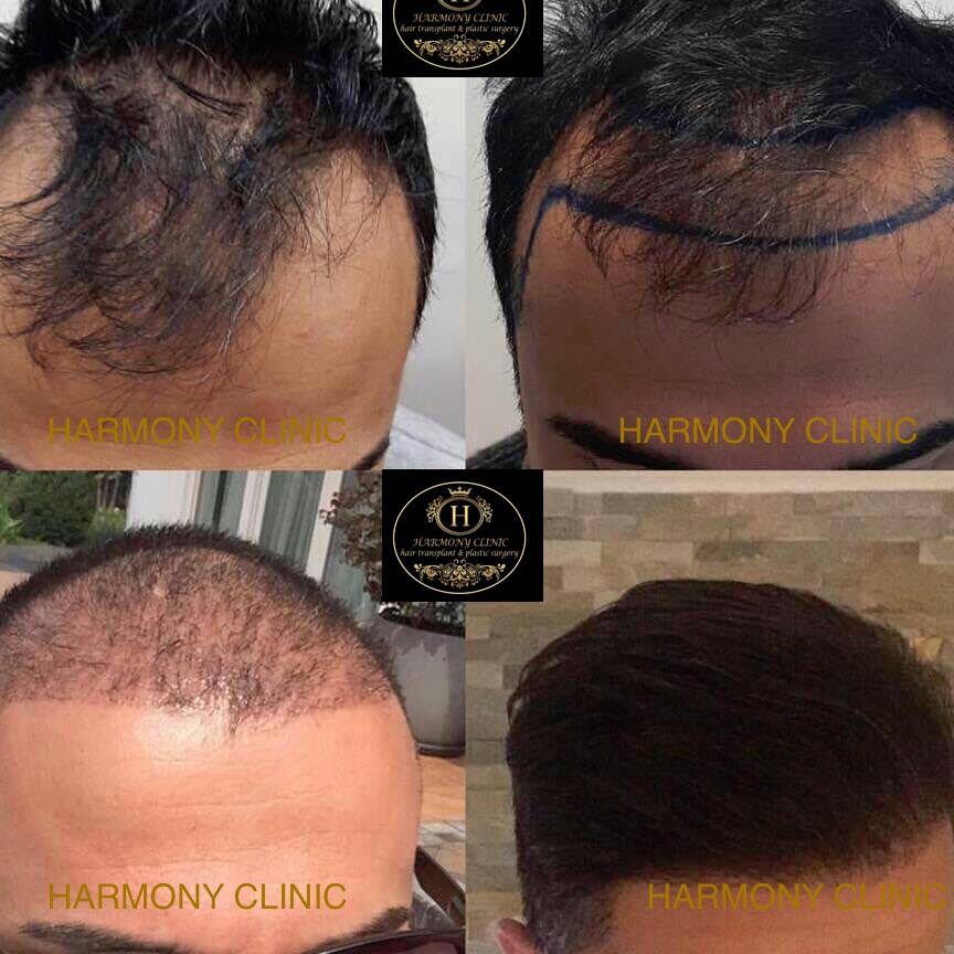 ¡Descubre las increíbles opiniones de los pacientes en Harmony Clinic México y transforma tu cabello! descubre las increibles opiniones de los pacientes en harmony clinic mexico y transforma tu cabello