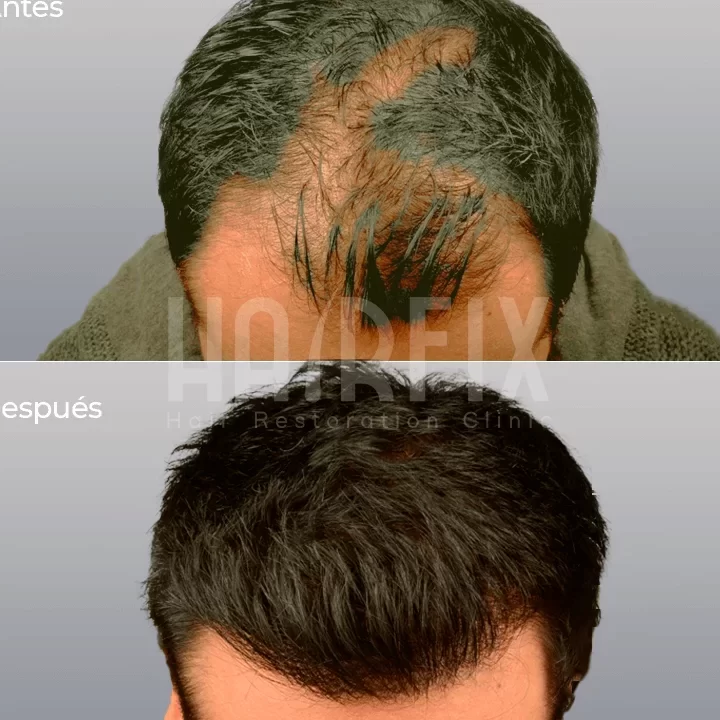 Implante de cabello en México: Todo lo que necesitas saber para recuperar tu confianza capilar implante de cabello en mexico todo lo que necesitas saber para recuperar tu confianza capilar