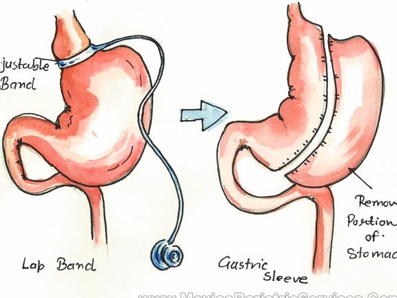 Lap Band Surgery in Monterrey, Mexico: A Comprehensive Guide lap band surgery in monterrey mexico a comprehensive guide
